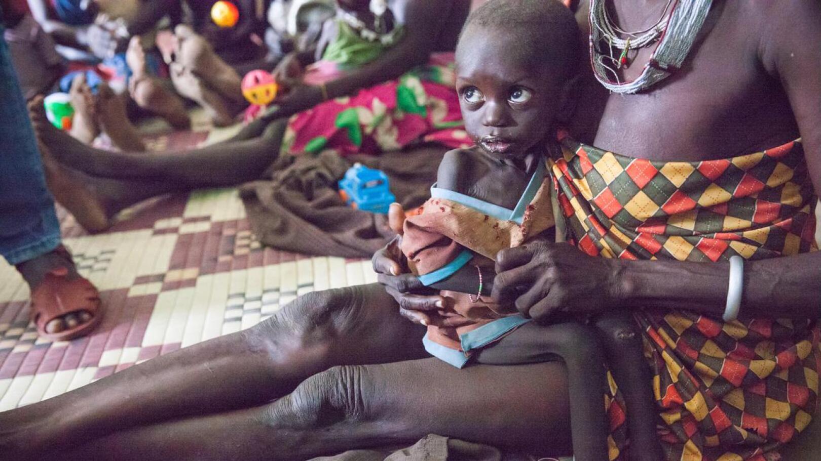 2-vuotias Lobato saa hoitoa vakavaan aliravitsemukseensa Unicefin tukemalla terveysklinikalla Kapoetan kaupungin pohjoispuolella alueella, joka on nälänhädän partaalla.